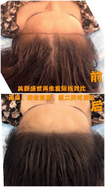 再生發(fā)效果展示五