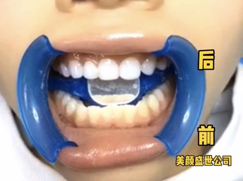 美牙效果對比五